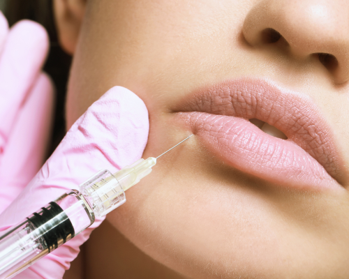 Acido ialuronico labbra: che cos’è e quali alternative esistono