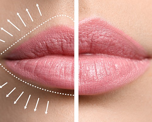 Labbra piene e carnose: 4 soluzioni efficaci a rischio zero